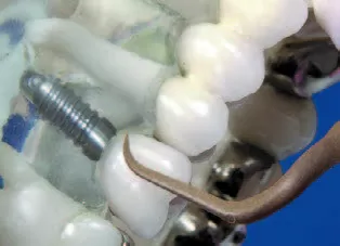 Купить Насадка для скалера #PH2R | Acteon в интернет-магазине dialog.dental
