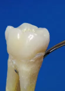 Заказать Насадка для скалера #TK2-1L | Acteon в интернет-магазине dialog.dental