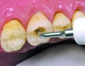 Заказать Насадка для скалера #ET40D | Acteon в интернет-магазине dialog.dental
