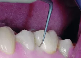 Заказать Насадка для скалера #P2R | Acteon в интернет-магазине dialog.dental
