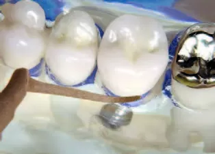 Заказать Насадка для скалера #PH2L | Acteon в интернет-магазине dialog.dental