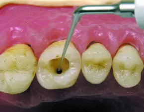 Заказать Насадка для скалера #ET40 | Acteon в интернет-магазине dialog.dental