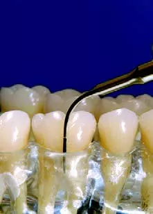 Заказать Насадка для скалера #10Z | Acteon в интернет-магазине dialog.dental