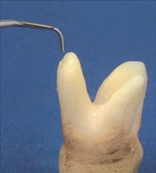 Заказать Насадка для скалера #P15RD | Acteon в интернет-магазине dialog.dental