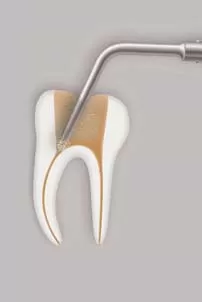 Заказать Насадка для скалера #CAP2 | Acteon в интернет-магазине dialog.dental