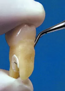 Заказать Насадка для скалера #H2R | Acteon в интернет-магазине dialog.dental