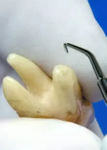Заказать Насадка для скалера #P15LD | Acteon в интернет-магазине dialog.dental
