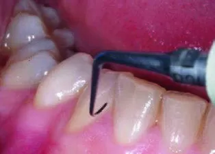 Заказать Насадка для скалера #P2L | Acteon в интернет-магазине dialog.dental