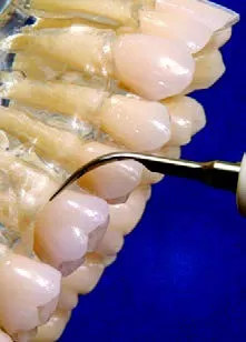 Приобрести Насадка для скалера #1 | Acteon в интернет-магазине dialog.dental