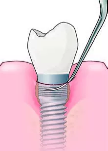 Заказать Насадка для скалера #IP3L | Acteon в интернет-магазине dialog.dental