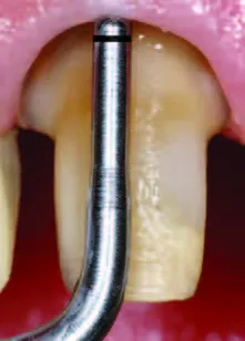 Заказать Насадка для скалера #PM3 | Acteon в интернет-магазине dialog.dental