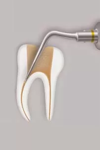 Заказать Насадка для скалера #CAP3 | Acteon в интернет-магазине dialog.dental