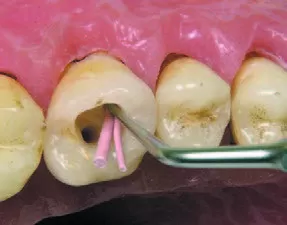 Заказать Насадка для скалера #S04 | Acteon в интернет-магазине dialog.dental