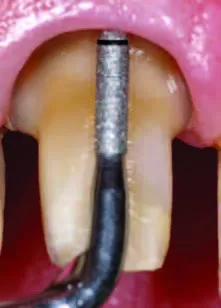 Заказать Насадка для скалера #PM2 | Acteon в интернет-магазине dialog.dental