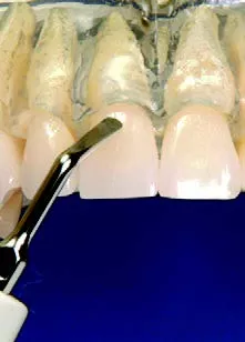 Заказать Насадка для скалера #3 | Acteon в интернет-магазине dialog.dental
