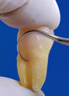 Заказать Насадка для скалера #TK2-1R | Acteon в интернет-магазине dialog.dental
