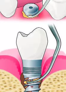 Заказать Насадка для скалера #IP1 | Acteon в интернет-магазине dialog.dental