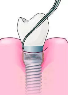Заказать Насадка для скалера #IP3R | Acteon в интернет-магазине dialog.dental